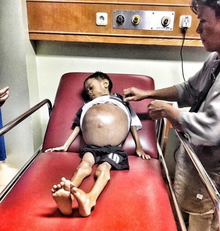 RS PMC Jemput dan Rawat Pitera, Anak 7 Tahun yang Perutnya Membengkak