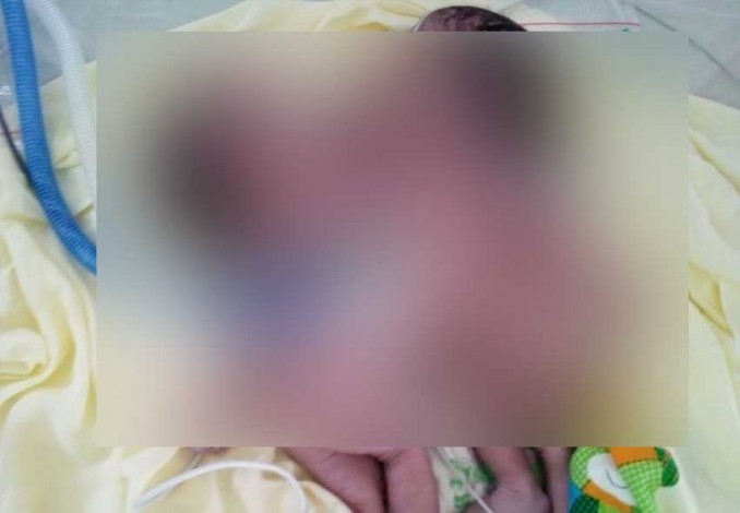 Hanya Bertahan 22 Jam, Bayi Kembar Siam Satu Jantung di RSUD Arifin Achmad Akhirnya Meninggal