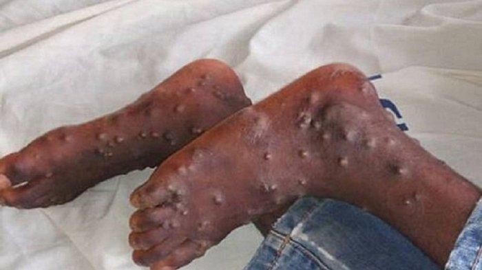 Dinkes Belum Temukan Kasus Monkeypox di Pekanbaru