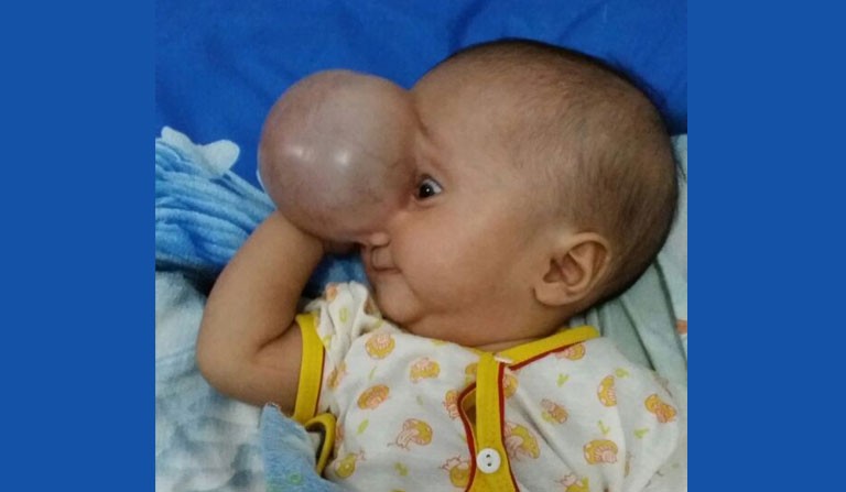 Tolong! Bayi Ini Butuh Uluran Tangan untuk Obati Tumor Besar di Wajah